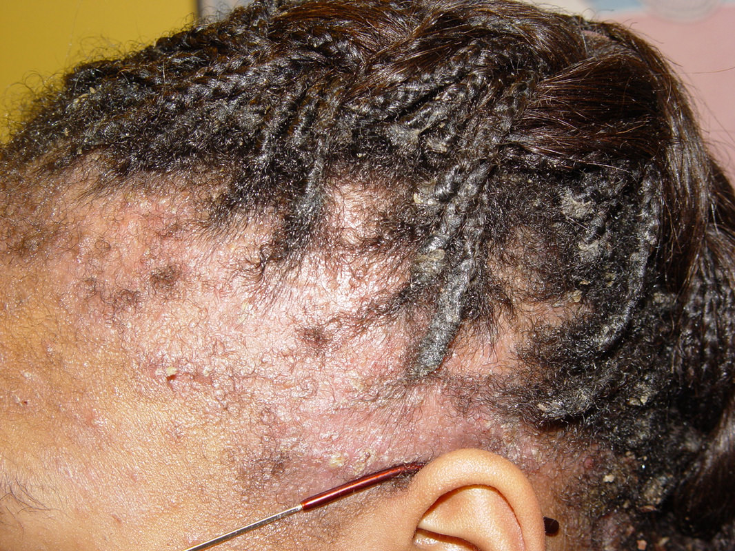 Natural Hair Buildup Or Fungus Natural Hair Buildup Or Fungus