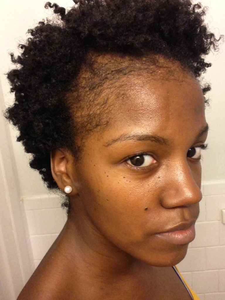 Spotty Natural Hair On Black Hair | help my edges are starting to thin what could be the Spotty Natural Hair On Black Hair | help my edges are starting to thin what could be the